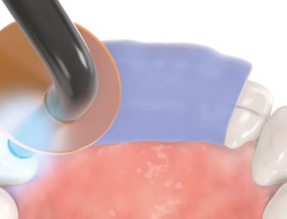 Bonding the anchor teeth