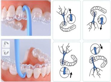 Aligner remover