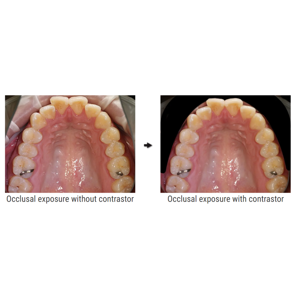 Contrastor 36 ocluzal (53mm)