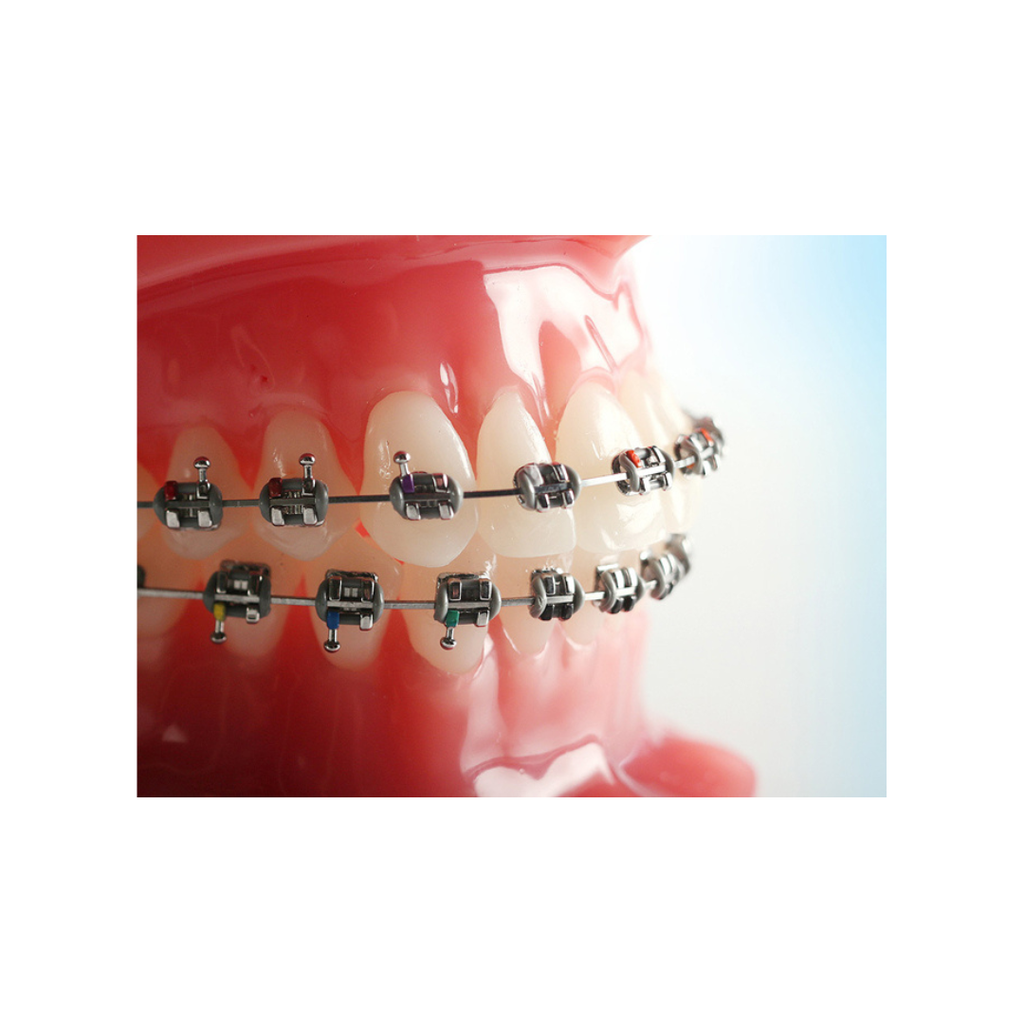 Bracket metalic miniPrevail Roth .022 Refill