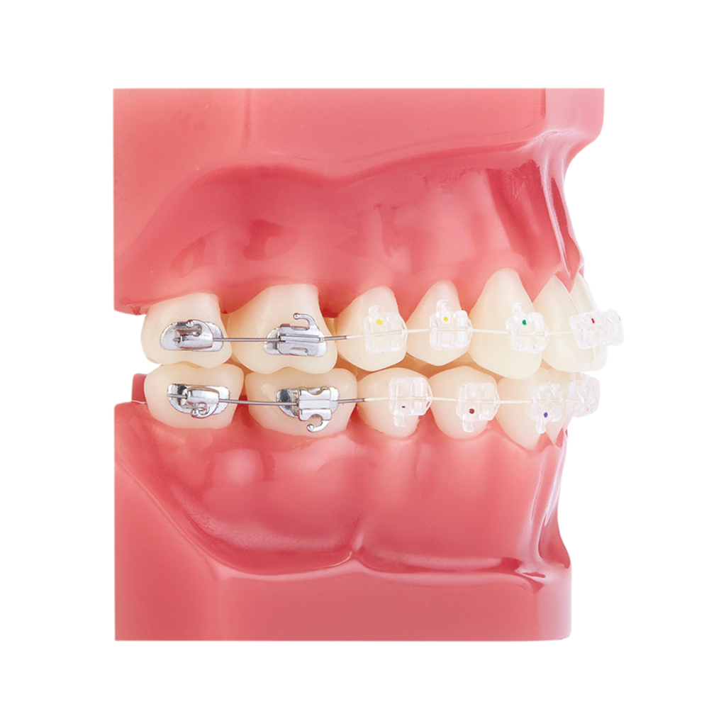 Set bracketi safir ClearViz+mini .022