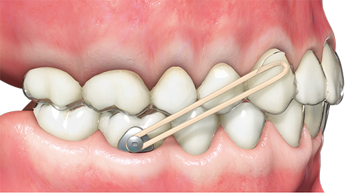 Buton colabil alignere metalic Precision